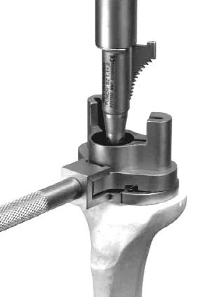 TIBIAL BASEPLATE REAMING Align the Press Fit Reamer Guide or Cemented Reamer Guide through the Keel Punch Guide A IN FIGURE 16.