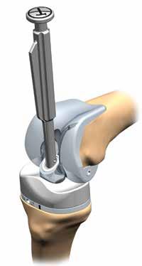 10. Insert the Sleeve through the Link Assembly and into the Tibial Base (Figure 25).