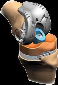 Replacing the LEGION HK linkage, femoral assembly or tibial assembly The LEGION HK is designed to accommodate Trial Components interfaces for accessing partial component replacements.