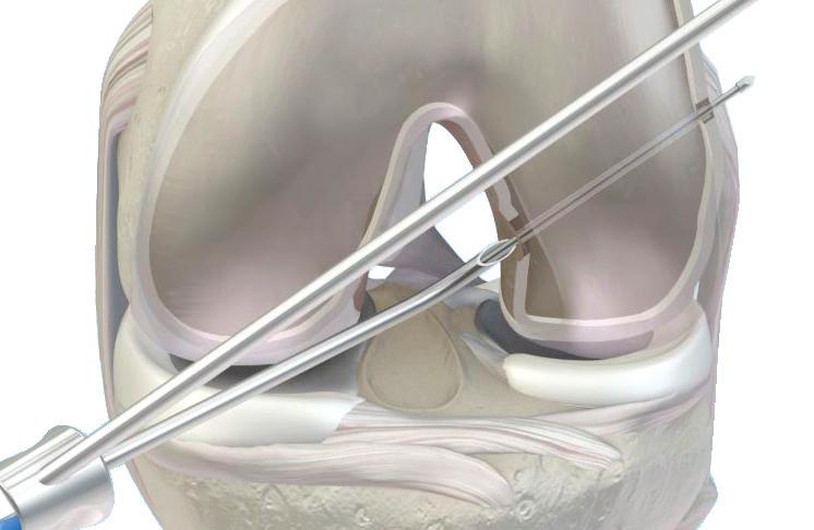 GraftMax Curved Guide into the AM portal with the knee flexed at 90º