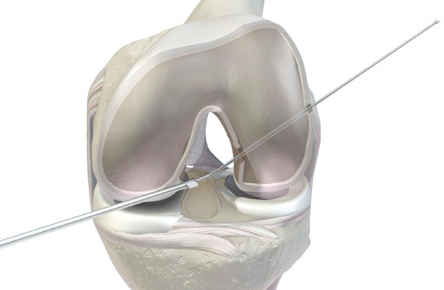 Curved Anatomic Soft Tissue ACL Reconstruction Using GraftMax Curved Reaming, GraftMax Button and GENESYS Matryx 9 Manually remove the Flex Sentinel from the