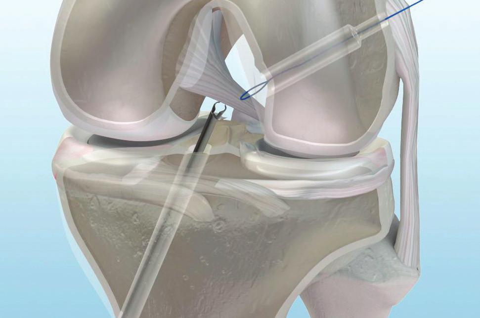 Place the tip of the guide into the center of the tibial ACL footprint and advance the pin