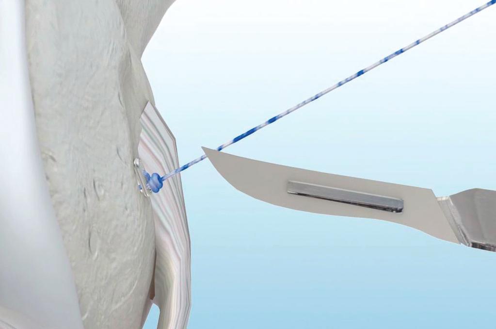 Curved Anatomic Soft Tissue ACL Reconstruction Using GraftMax Curved Reaming, GraftMax Button and GENESYS Matryx If