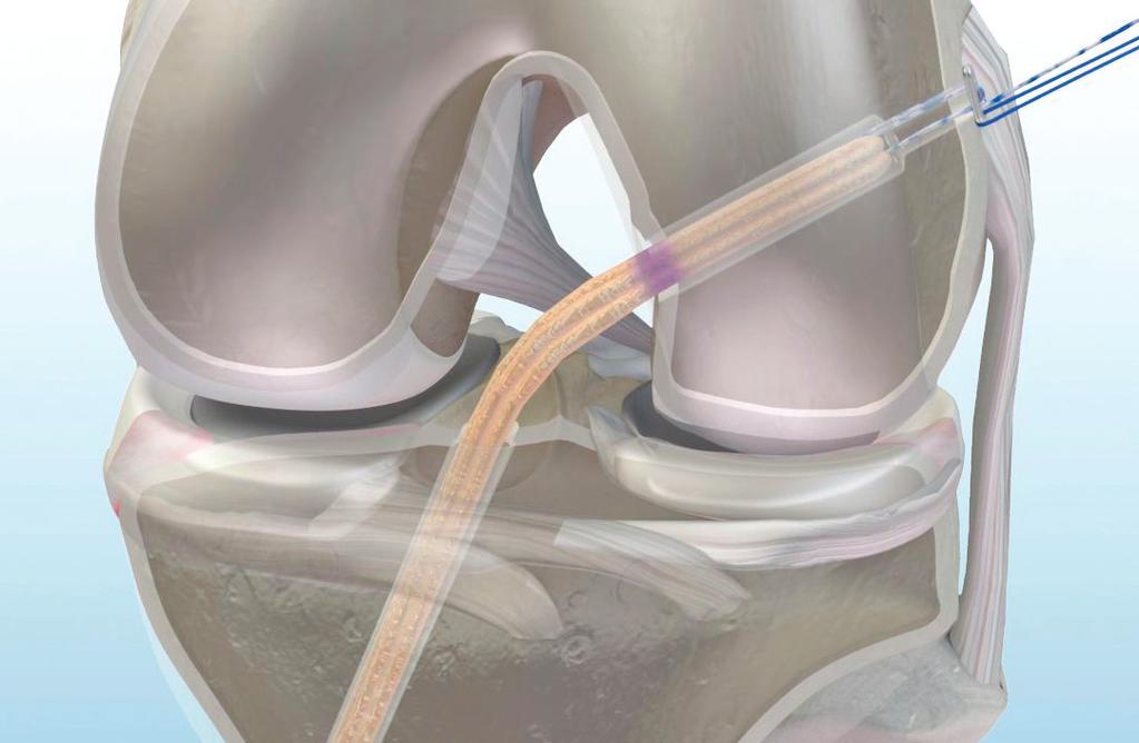 21 23 Pull the soft tissue graft into the joint by pulling the striped adjustable loop reducing the loop length