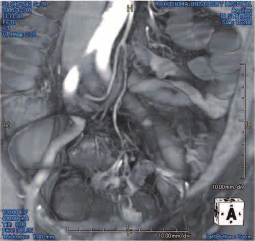 Lymph node Tumor Tumor : inferior mesenteric artery : superior rectal artery S1 : first sigmoid