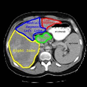 Assessing Metastasis With CT IVC From BIDMC Databases Focal parenchymal lesions with
