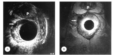 Endorectal MRI From Hussain, S. Imaging of Anorectal Diseases.