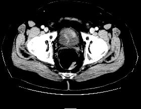 CT From BIDMC Databases Seen as intraluminal masses with focal or circumferential wall thickening Masses as small as 6mm can be detected Differential