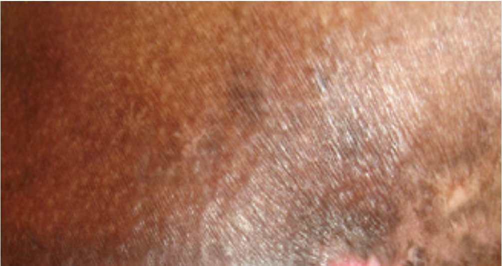 Partial thickness skin loss involving epidermis, dermis or both.