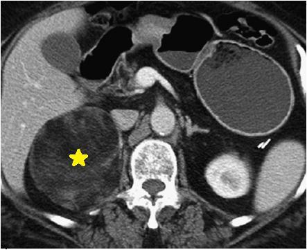 Companion Patient #1: Myelolipoma Axial contrast CT shows a 9cm right adrenal mass containing large amounts of fat, diagnostic of