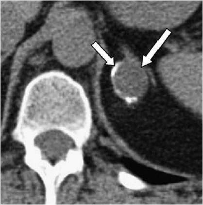 Companion Patient #2: Benign Adrenal Cyst Non-contrast CT shows a 1.