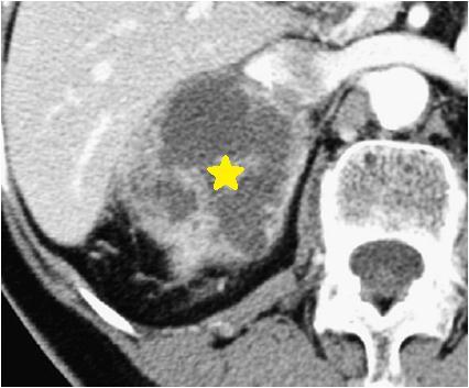 Companion Patient #3: Metastasis Contrast-enhanced CT shows a 7cm heterogeneous and necrotic right adrenal confirmed to be metastatic when compared