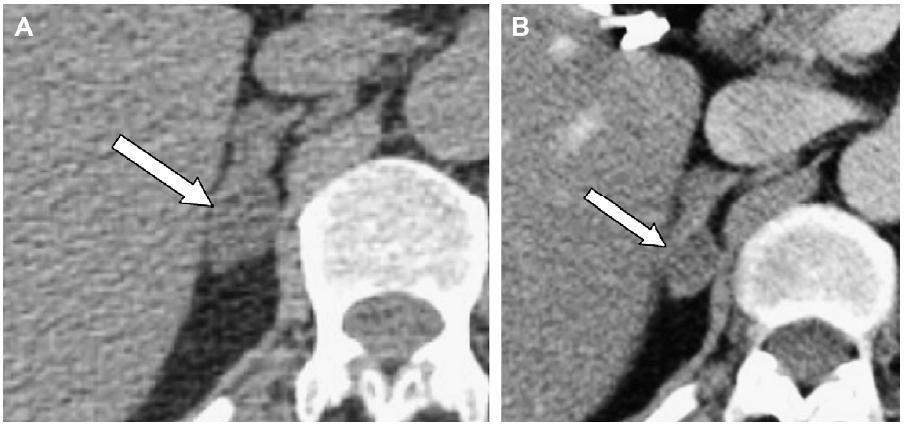 Companion Patient #4: Serial Imaging Non-contrast CT taken 4 years apart of a 1.