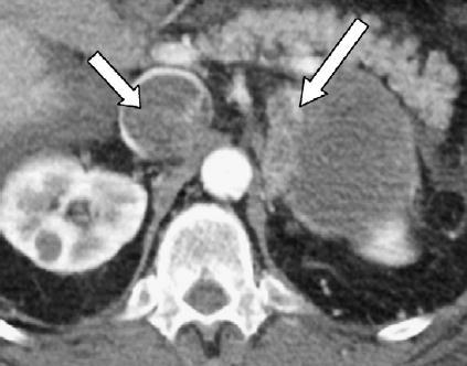 Companion Patient #5: Typical Presentation of Adrenocortical Carcinoma on CT Contrast-enhanced CT showing 8.