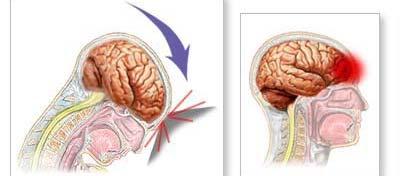 Concussions A concussion is a brain injury that is caused by a sudden blow to the head or to the body.