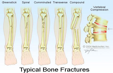 Fractures Two types