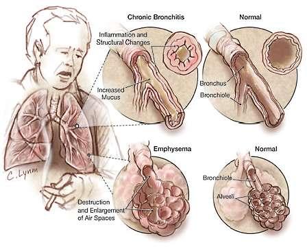 COPD Chronic Obstructive Pulmonary