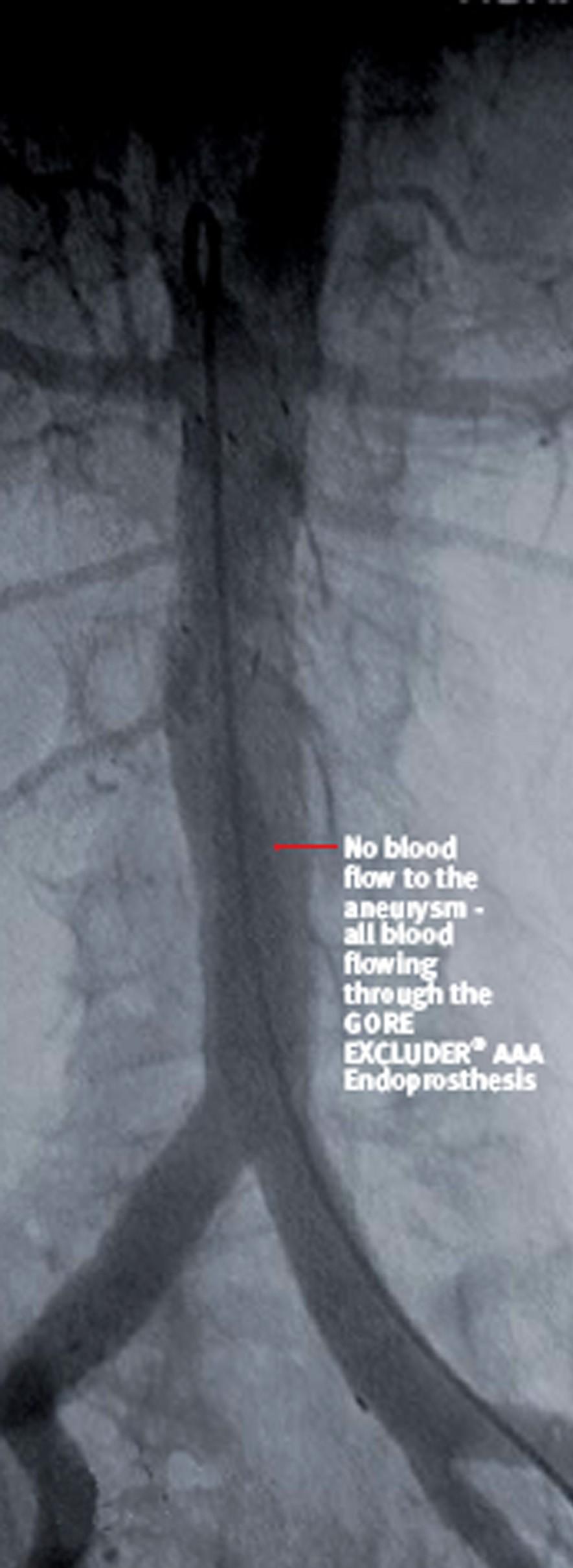and below AAA in normal arterial segments Hemostatic seals