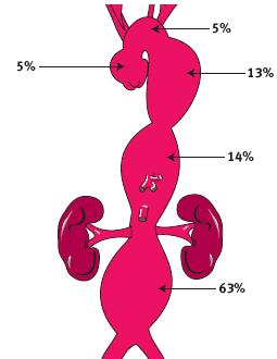 AAA Incidence and Location Incidence of aortic aneurysms Each year, physicians diagnose approximately