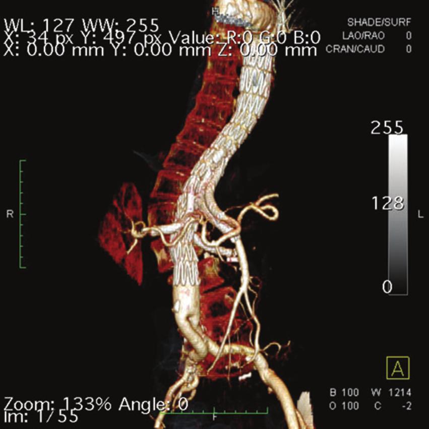 Spinal cord protection in aortic endovascular surgery ii27 Table 1 Spinal cord ischaemia outcomes (percentage incidence) related to the Crawford classification of thoracoabdominal aneurysm extent for