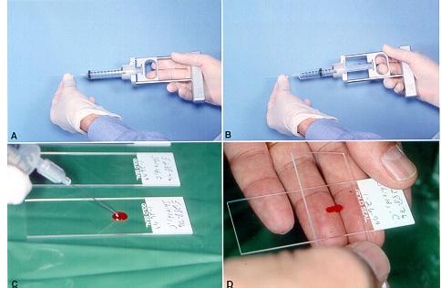 Fine-needle aspiration biopsy Most accurate and cost-effective method False-negative rate 2-4%