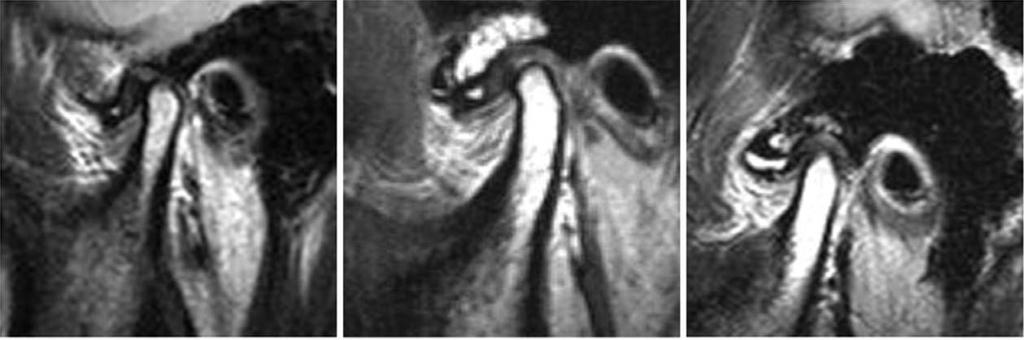 Relationship between pain and effusion on magnetic resonance imaging in temporomandibular disorder patients that joint effusion was found in 80% of painful joints and in 39% of pain-free joints