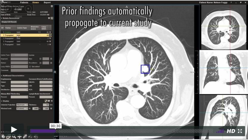 Background and disclosures 1996-2001: PhD Detection of tuberculosis in chest radiographs: CAD4TB now in use in >20 countries 2004: Research on automated