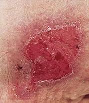 Stage 2 Stage 2: Partial-thickness loss of skin with exposed dermis. The wound bed is viable, pink or red, moist, and may also present as an intact or ruptured serumfilled blister.