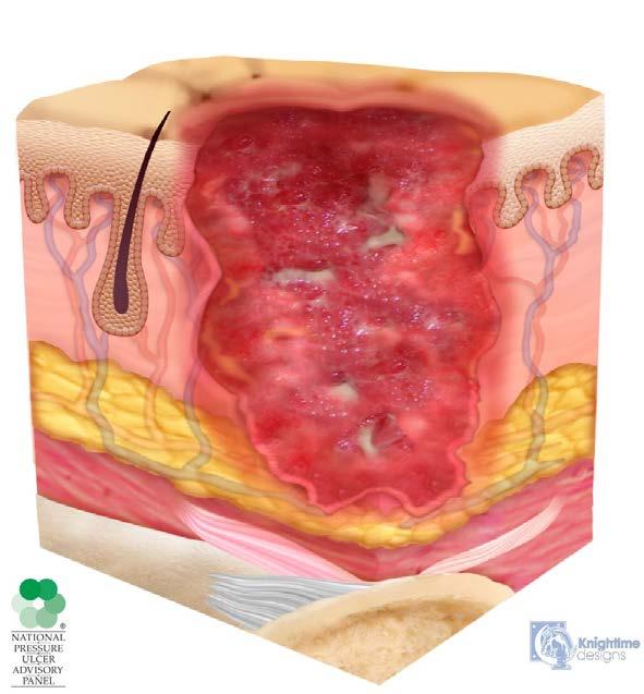 Stage 3 Stage 3: Full-thickness loss of skin, in which adipose (fat) is visible in the ulcer and granulation tissue and epibole (rolled