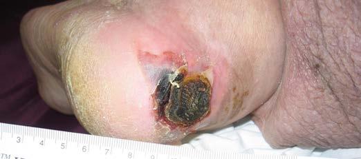 Unstageable Pressure Injury Unstageable: Full-thickness skin and tissue