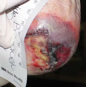 Deep Tissue Pressure Injury Suspected Deep Tissue Injury: Purple or maroon localized area of discolored intact skin or blood-filled blister due to damage of