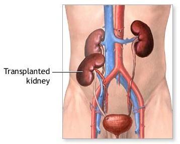 Tissue rejection Transplants involve replacing a damaged organ with a donor organ.