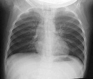 25 50% of patients have normal PE and radiograph History is the