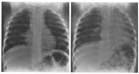 aspiration: A hyperinflated right lung and a leftward mediastinal