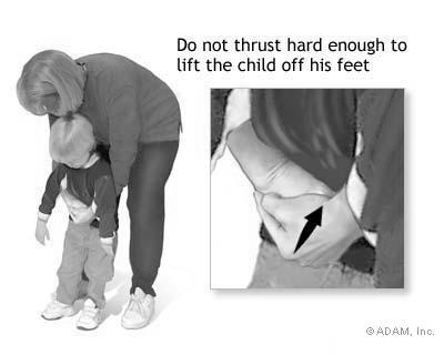 airway obstruction: Infant: Back blows/abdominal thrusts Child: Heimlich maneuver A. Blind finger sweep B.
