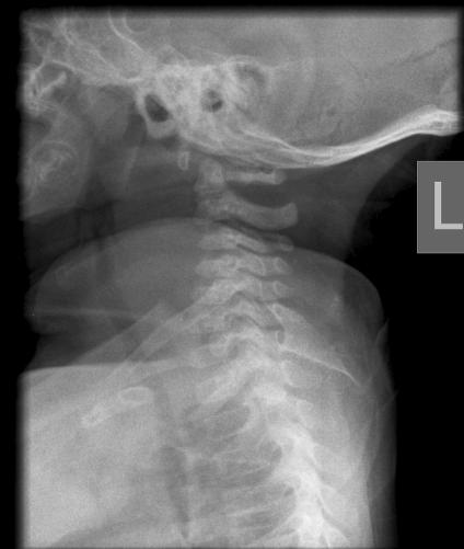 decreased ROM, drooling Radiologic: Lateral neck plain film, CT