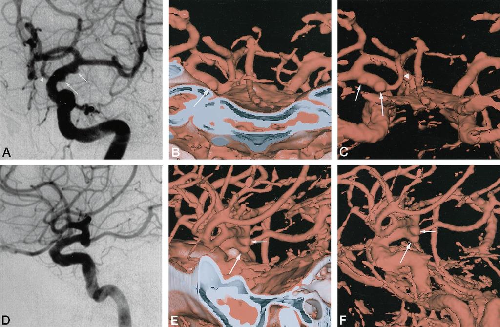 AJNR: 19, February 1998 INTRACRANIAL ANEURYSMS 293 FIG 1. Case 1: Patient with aneurysms of the left ICA-PCA and left ICA-anterior choroidal artery.