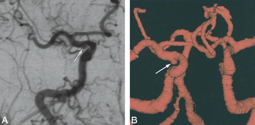 294 IMAKITA AJNR: 19, February 1998 FIG 2. Case 10: Patient with an aneurysm of the right ICA-PCA. A, Right carotid angiogram (anteroposterior view) shows ICA-PCA aneurysm (arrow) directed downward.