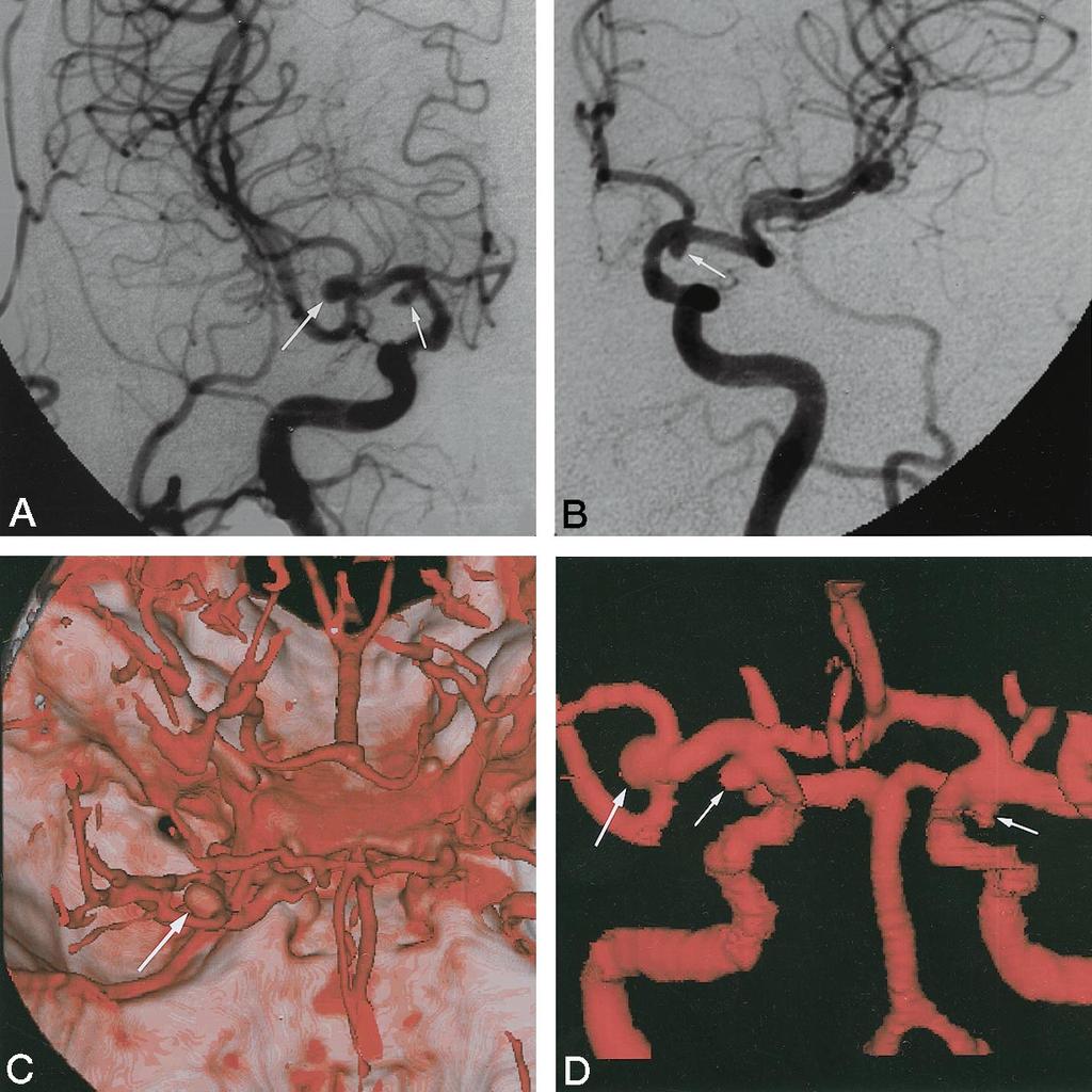Case 18: Patient with an aneurysm of the right MCA bifurcation and bilateral aneurysms of the ICA-anterior choroidal artery who had prior clipping of an aneurysm of the left MCA bifurcation.