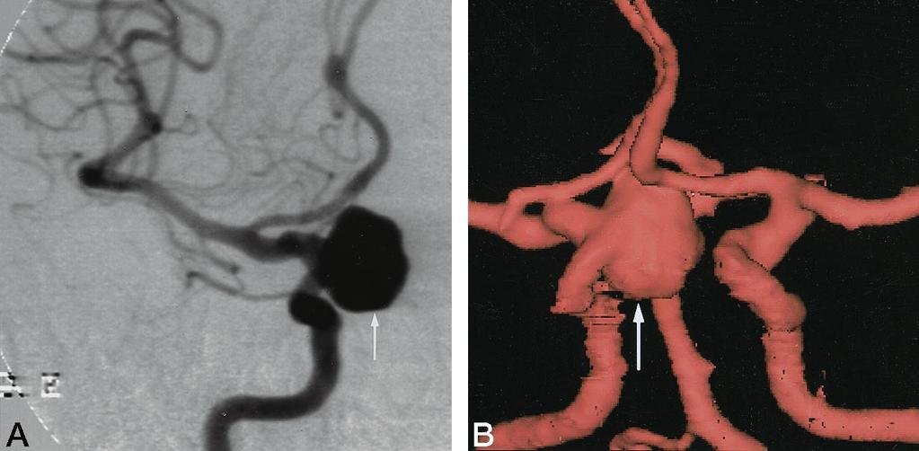 B, Left carotid angiogram (anteroposterior view) shows ICA-anterior choroidal artery aneurysm (arrow). C, Three-dimensional CT angiogram (superior view) shows right MCA bifurcation aneurysm (arrow).