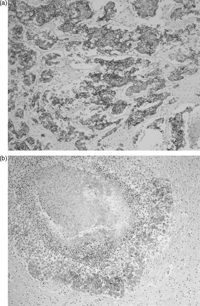 744 HER-2 overexpression metastatic breast cancer Figure 1. (a) Microscopic findings of the primary tumor, HER-2 score 3þ, (b) site of brain metastasis, HER-2 score 1þ (Hercep Test II, TM 100).