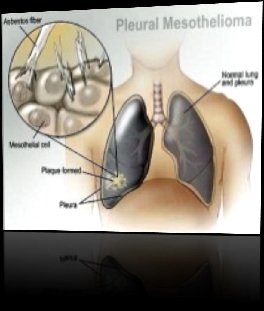 Diseases Related to the Result of an Exposure Mesothelioma cancer of the lining of the lung Lung Cancer Asbestosis Scarring of Lung Tissue Pleural Plaques