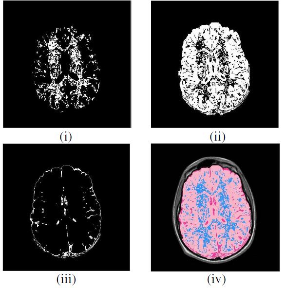 X p u ; p u t 3, t 5 & t 4 = (6) 0 ; otherwise Experimental Results The proposed brain tissue segmentation technique is implemented in the working platform MATLAB (version 7.