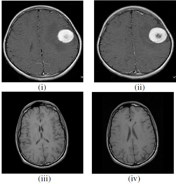 1: The sample input of normal and abnormal images The input images are classified by two FFBNN networks.