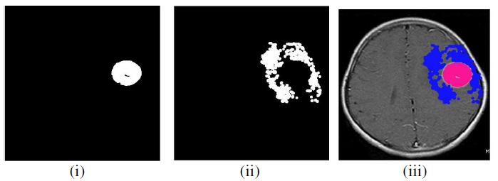 Fig.3: (i) Histogram Equalized image (ii) HSVmodel (iii)hsvthresholding (IV) closing (v) Edema region (VI) Closing (vii) Dilation 3. Conclusion Fig.