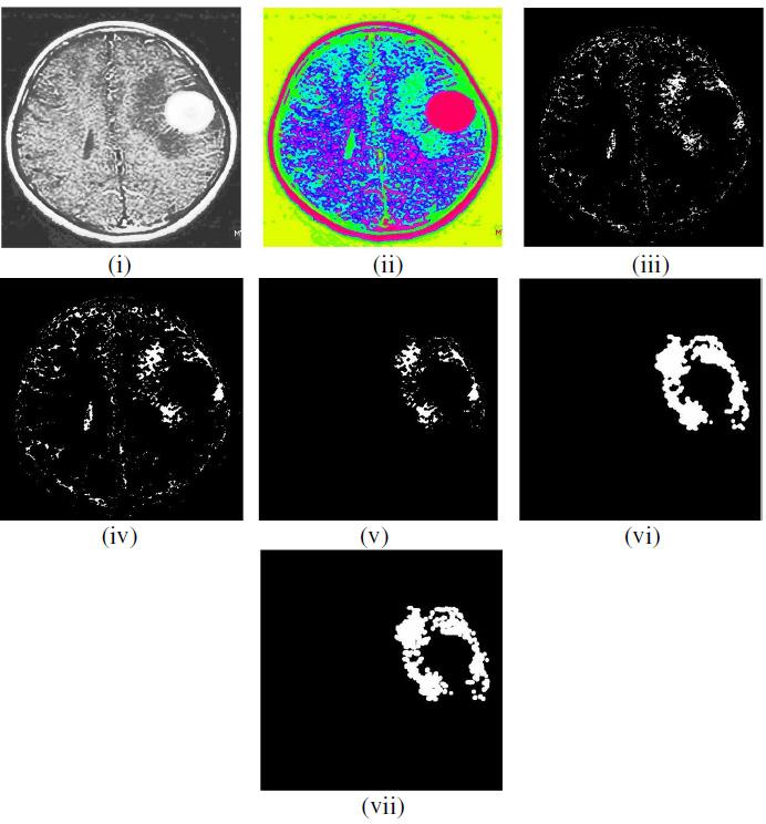 pathological tissues from the MRI brain images. The performance of the proposed segmentation was analyzed using defined set of MRI normal and abnormal images.