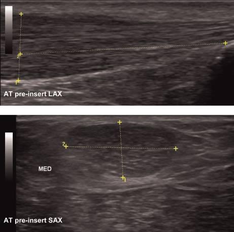 Figure A2 Pre-insertional: grey scale long and short axis image of Achilles tendon pre-insertion section.