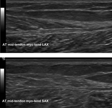 Grey scale measurements maximum thickness of the Achilles tendon is applied if relevant (not demonstrated).