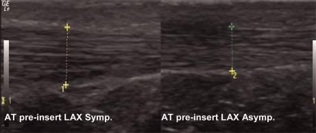 A diagnostic ultrasound power Doppler image of the Achilles tendon in the short axis is mandatory Figure A5 Pre-insertion: grey scale images using split screen to