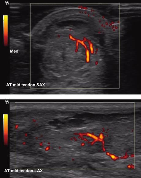 Figure A7 Pre-insertion: power Doppler short and long axis image of the Achilles tendon. (Fig. A7). Power Doppler in long axis is non-mandatory. Relevant settings and annotation included.